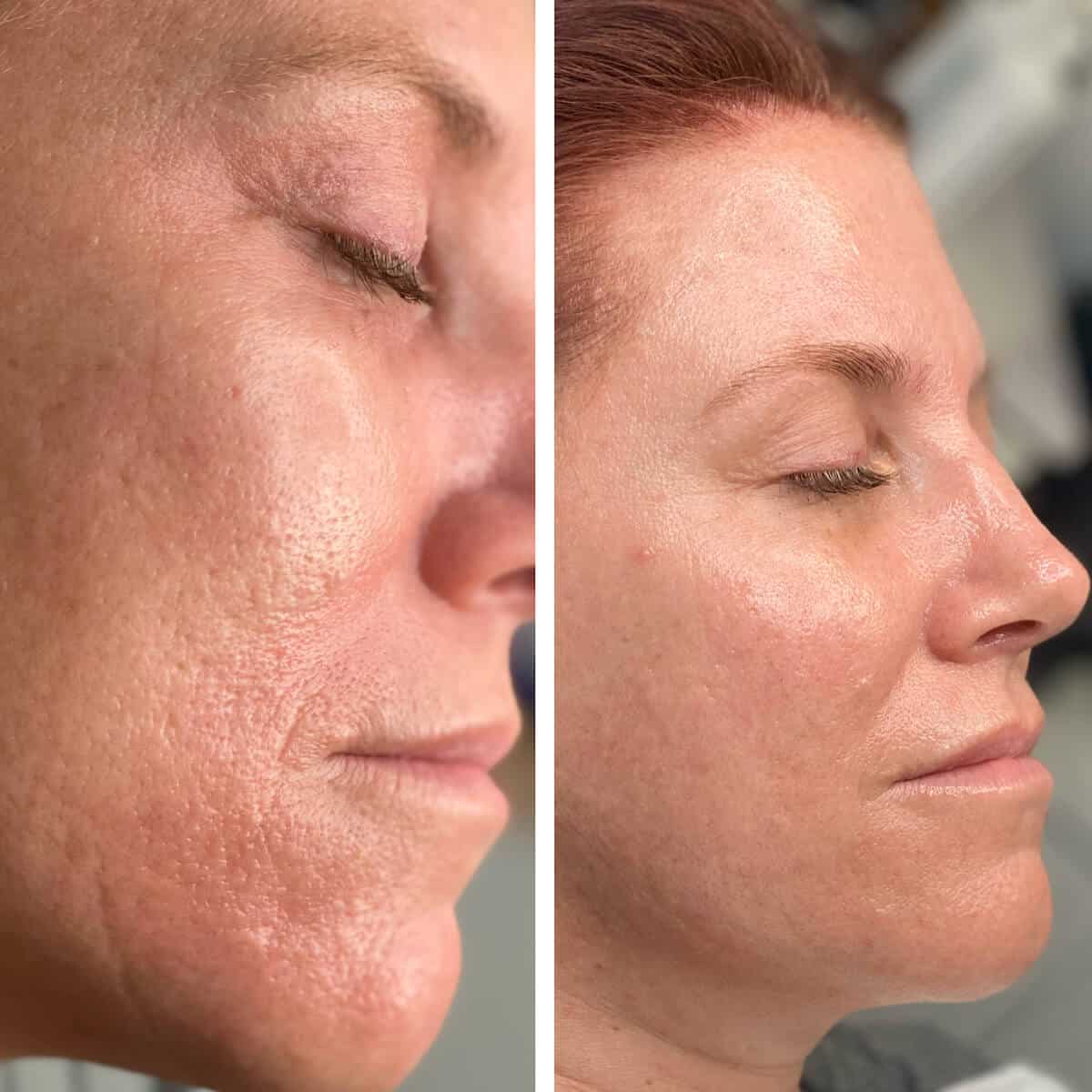 Smoother Skin Texture Results With Microneedling In Phoenix, Az - Waters Aesthetics